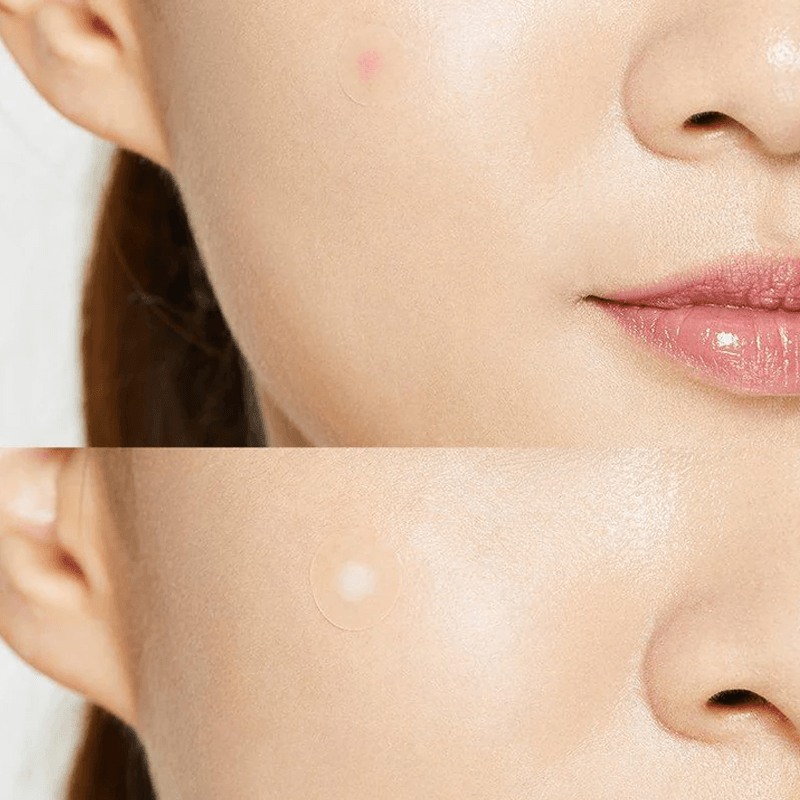 درمان سریع و موثر جوش ها با پچ ضد جوش کوزارکس مدل Acne Pimple Master Patch